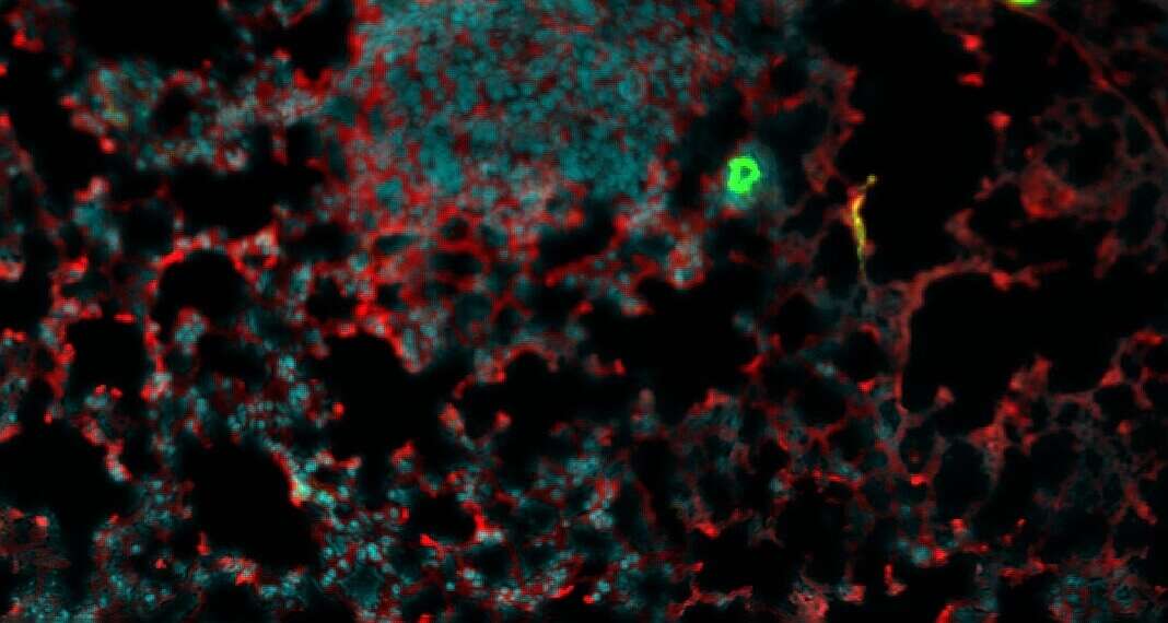 cáncer de mama metástasis